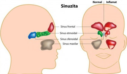 sinuzita