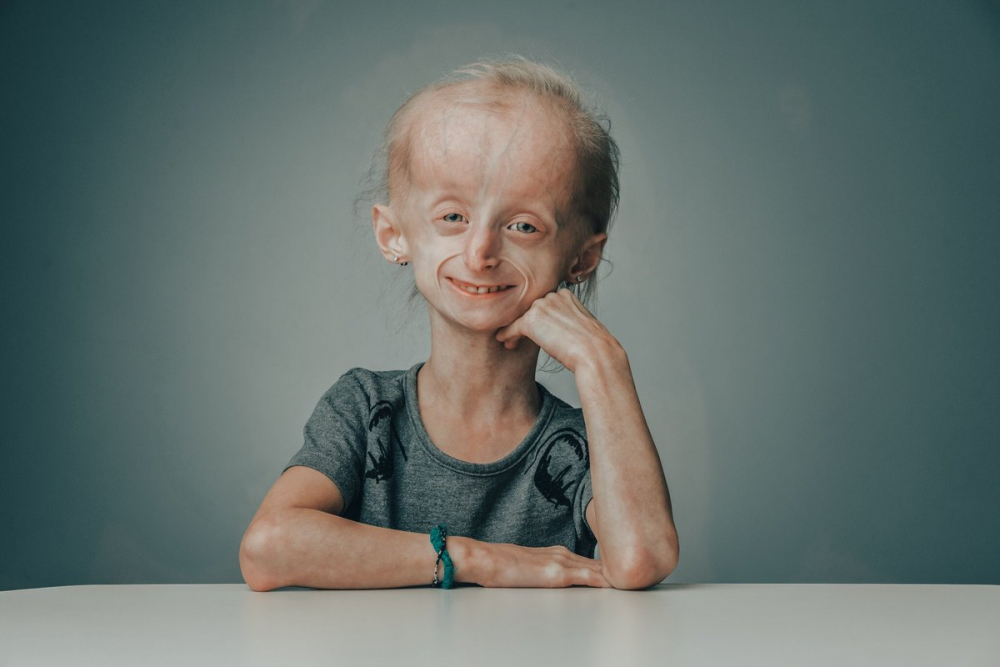 Progeria sau sindromul Hutchinson-Gilford: simptome și tratament
