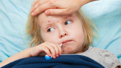 Numărul copiilor care s-au îmbolnăvit de varicelă a crescut considerabil în martie