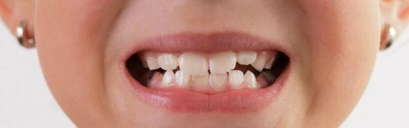 defect-dentar