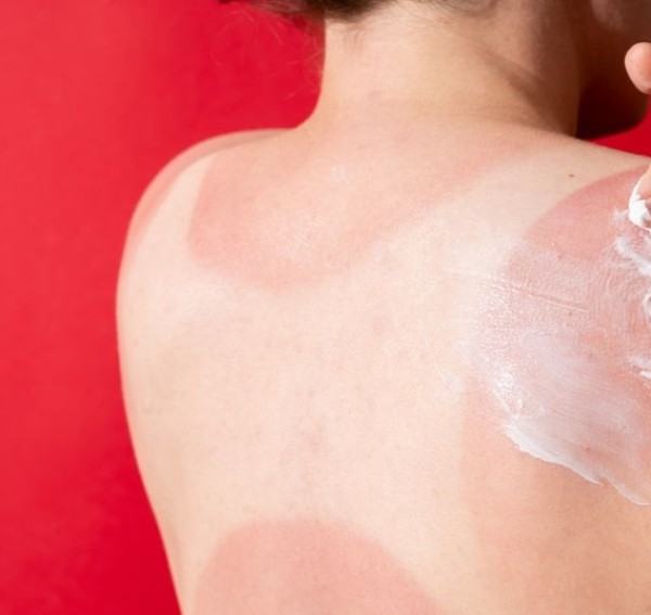 Pas cu pas de la specialist: ce să faci când copilul are arsuri solare