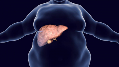 Ficatul gras la adolescenti - la ce riscuri e expus tanarul adult