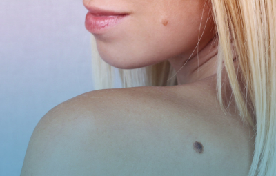Melanomul la copii si adolescenti: factori de risc