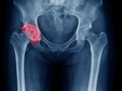 Sinovita de șold la copil. Cum o recunoști