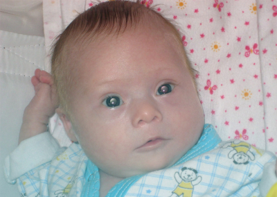 Fenilcetonuria la copii - ce este si cum se trateaza