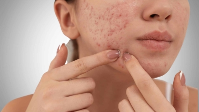 Dermatolog Florentina Zaharia:  Îngrijirea pielii și tratarea acneei la adolescente